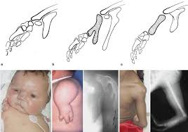 Phocomelia: Straighten out the  puzzle of a Rare Congenital Condition-thumnail