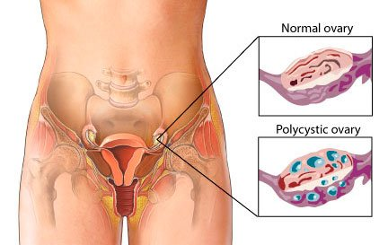 PCOS especially for women experiencing irregular menstrual cycles
