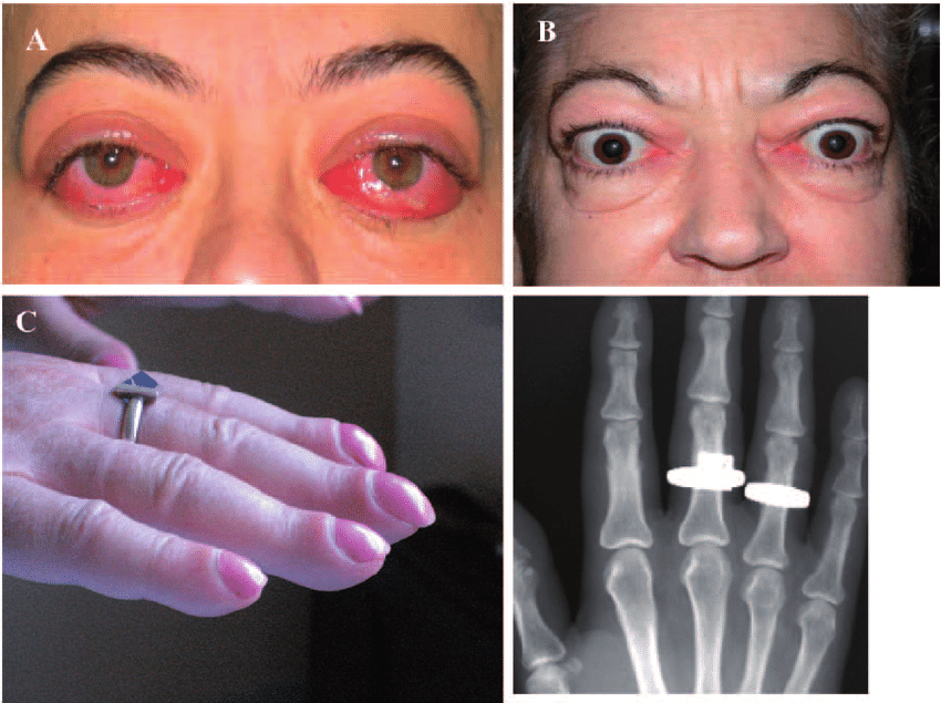 What is Graves’ Disease? Daisy Ridley Reveals Autoimmune Disorder Diagnosis-thumnail