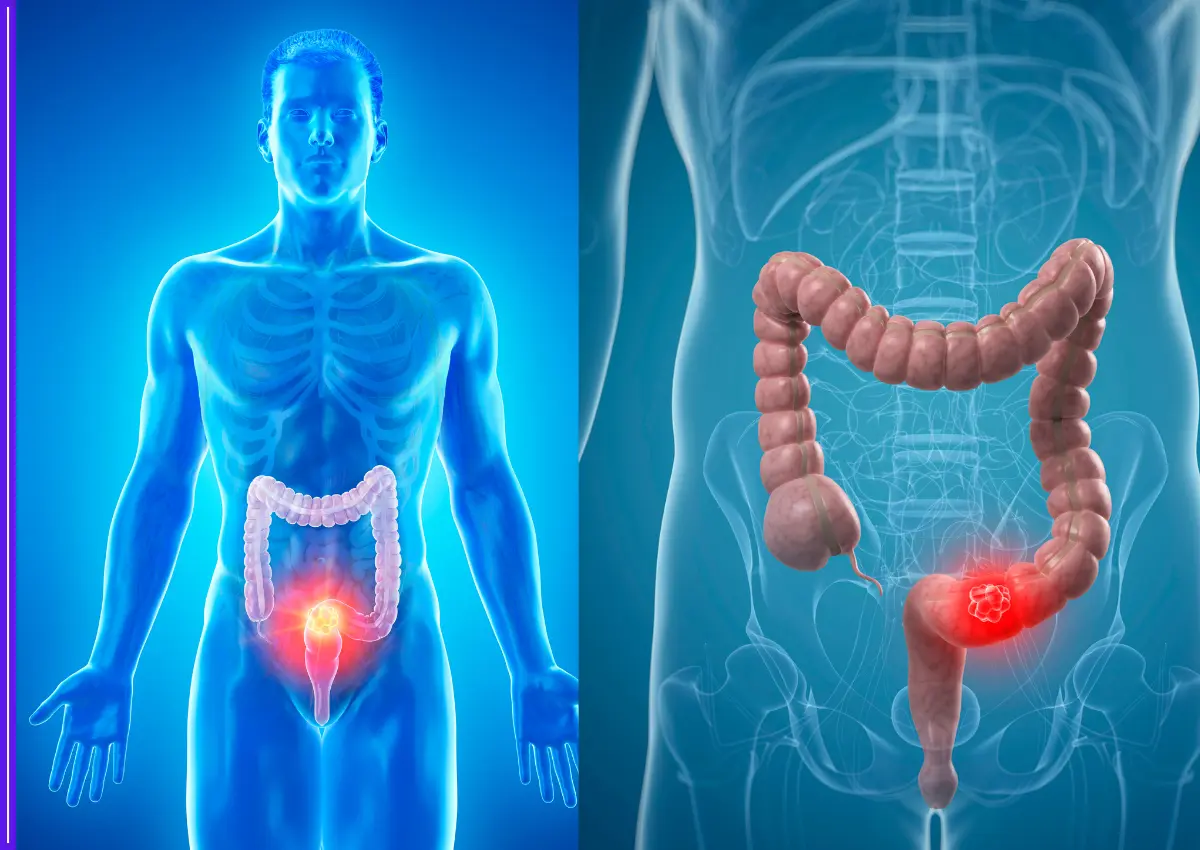 Five Common Signs of Colon Cancer You Should Never Ignore-thumnail