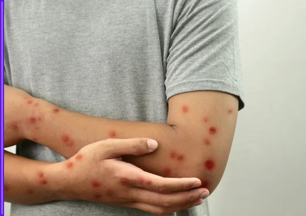 UK Health Agency Warns of Rising Clade Ib Mpox Cases Across Europe and the US 1 mpox